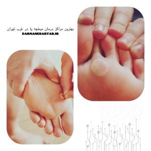 میخچه پا در غرب تهران