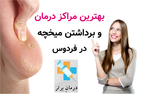 بهترین مراکز درمان و برداشتن میخچه در فردوس