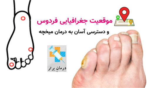 موقعیت جغرافیایی فردوس و دسترسی آسان به درمان میخچه